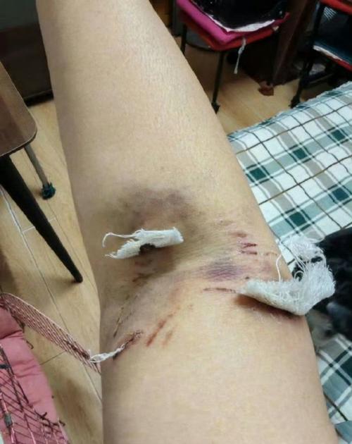 下车睡觉被狼咬伤,下车睡觉被狼咬伤了